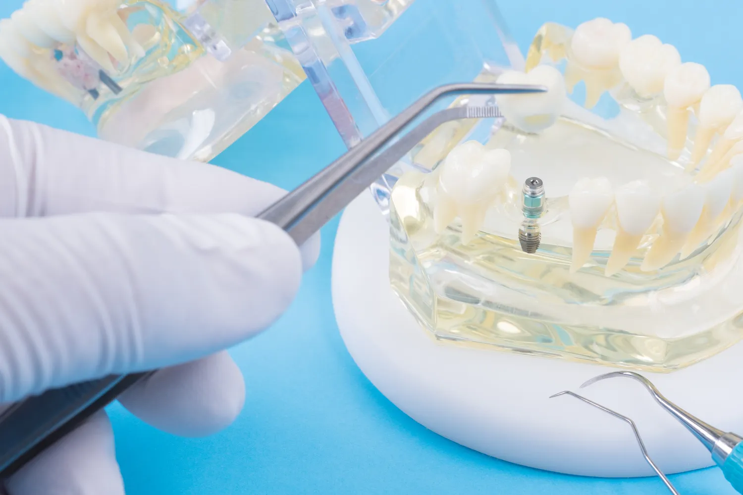 Co należy wiedzieć przed wyborem implantu zęba?