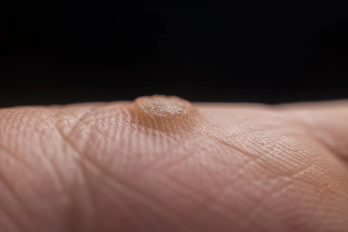 Co zrobić na kurzajki?